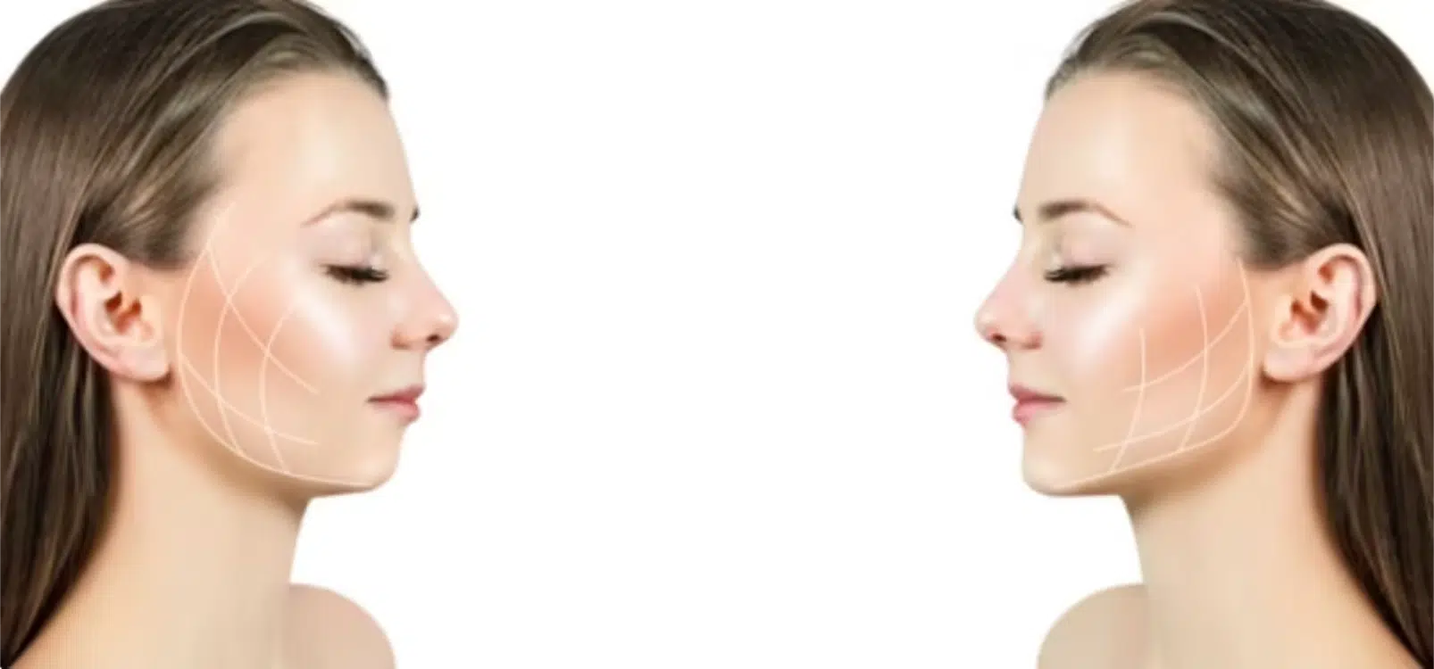 Jawline Filler before and after