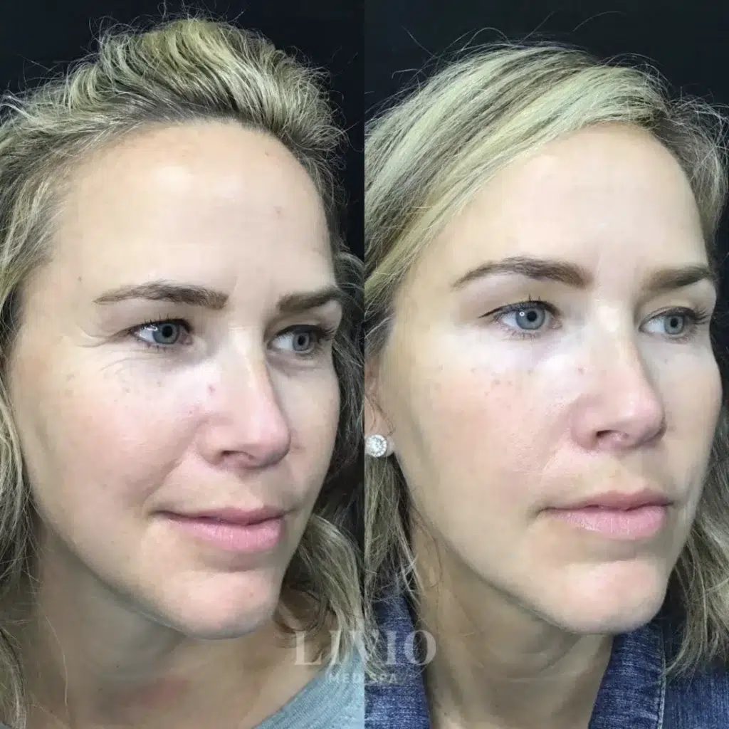botox before and after photo by livio med spa in cincinnati oh