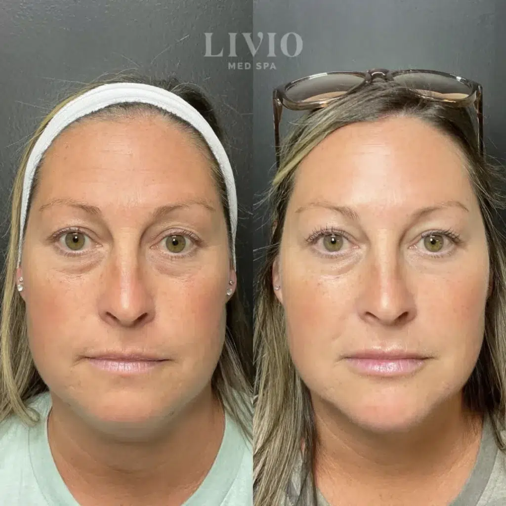botox before and after photo by livio med spa in cincinnati oh