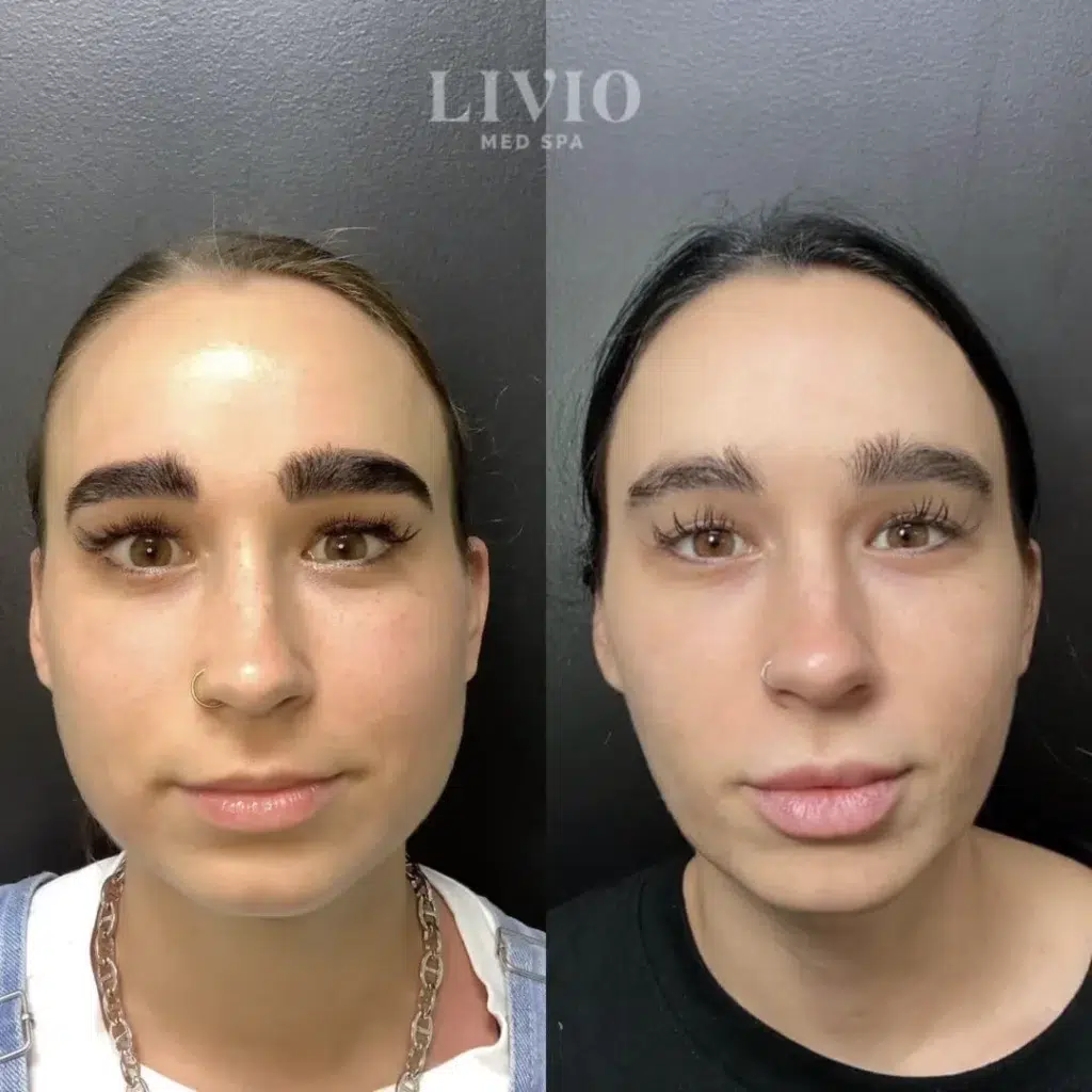 botox before and after photo by livio med spa in cincinnati oh