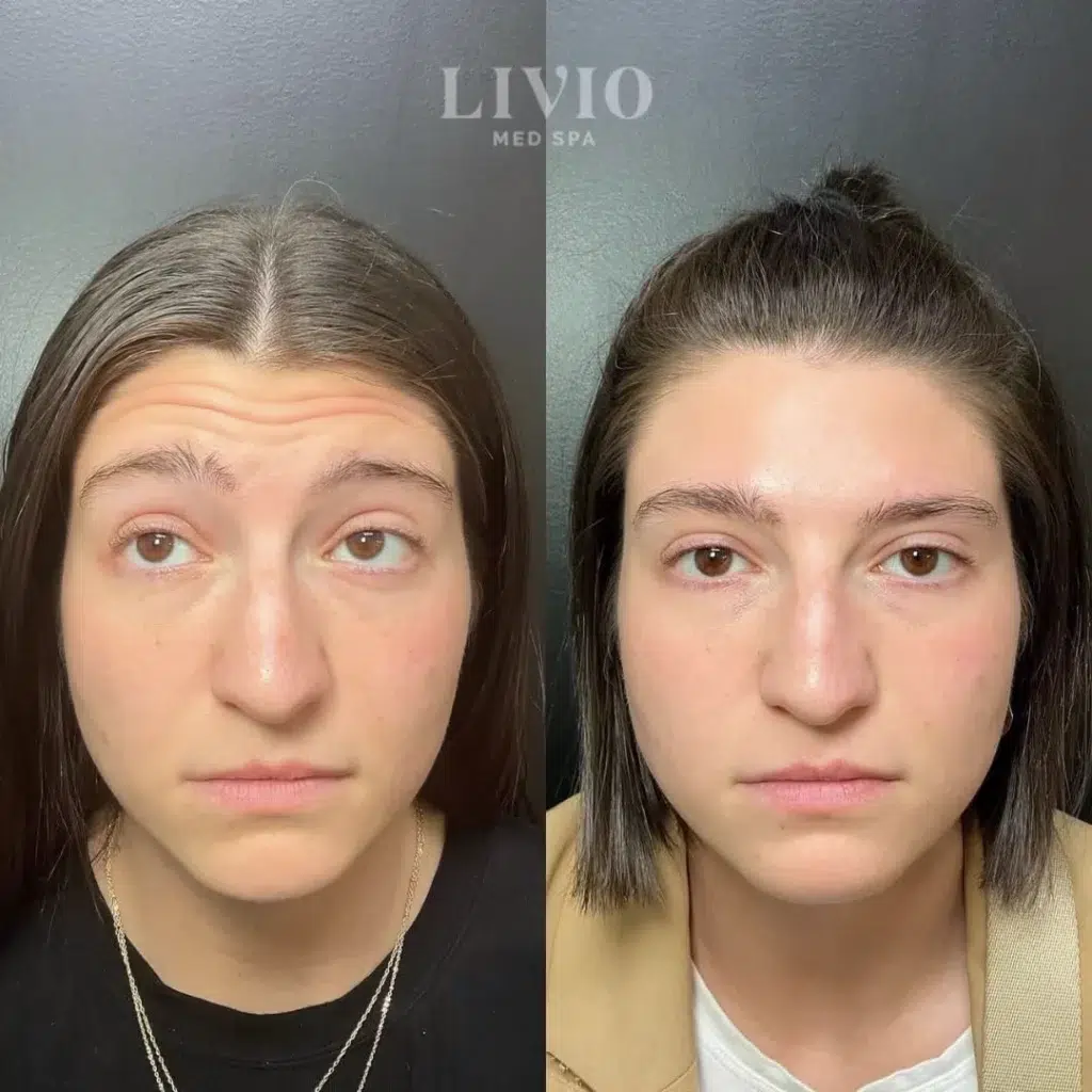 botox before and after photo by livio med spa in cincinnati oh