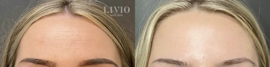 botox before and after photo by livio med spa in cincinnati oh