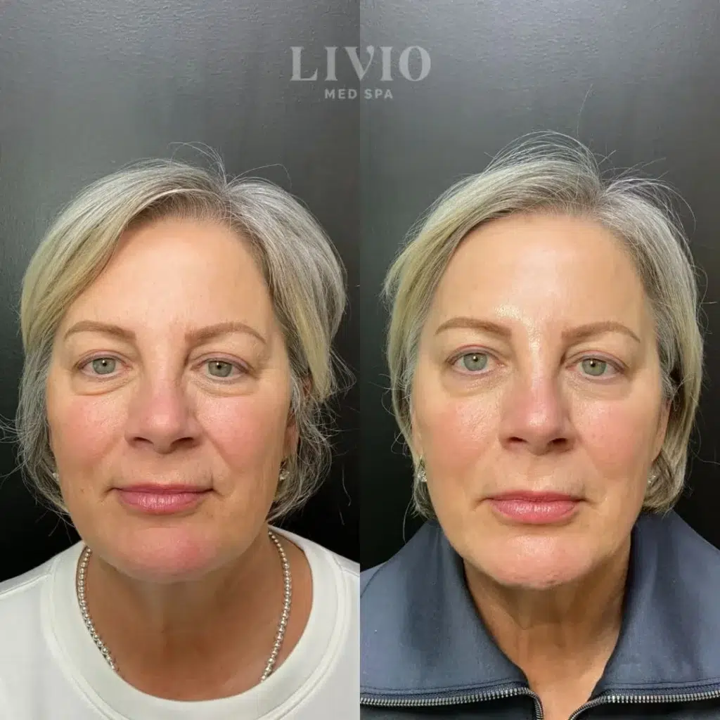 bbl laser before and after photo by livio med spa in cincinnati oh