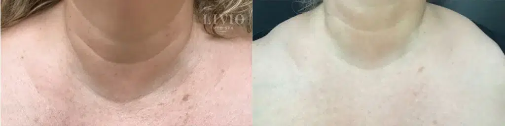 bbl laser before and after photo by livio med spa in cincinnati oh