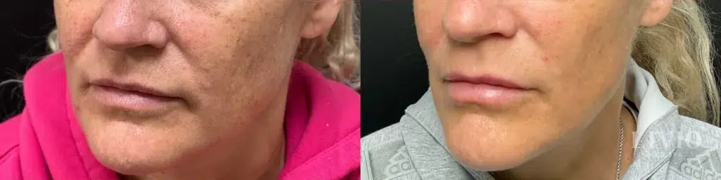 bbl laser before and after photo by livio med spa in cincinnati oh