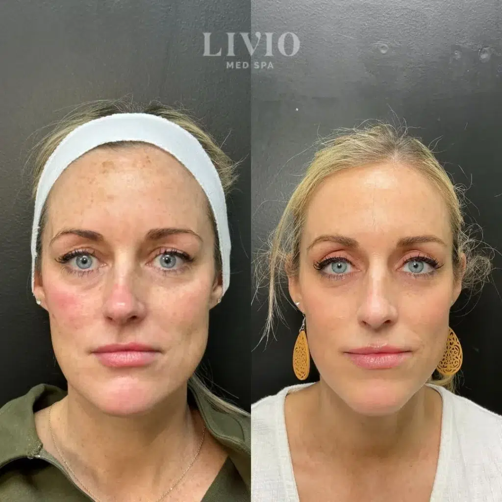 bbl laser before and after photo by livio med spa in cincinnati oh