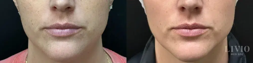 bbl laser before and after photo by livio med spa in cincinnati oh