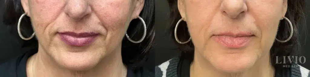 bbl laser before and after photo by livio med spa in cincinnati oh