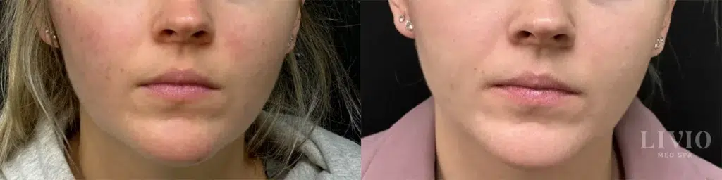 bbl laser before and after photo by livio med spa in cincinnati oh