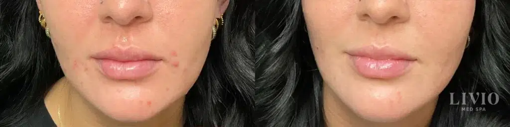 vi peels before and after photo by livio med spa in cincinnati oh