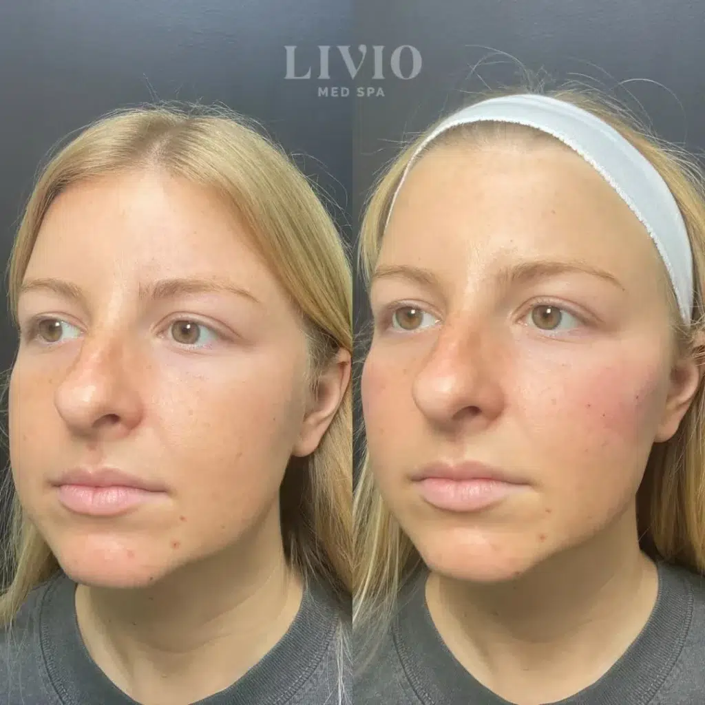 cheek filler before and after photo by livio med spa in cincinnati oh