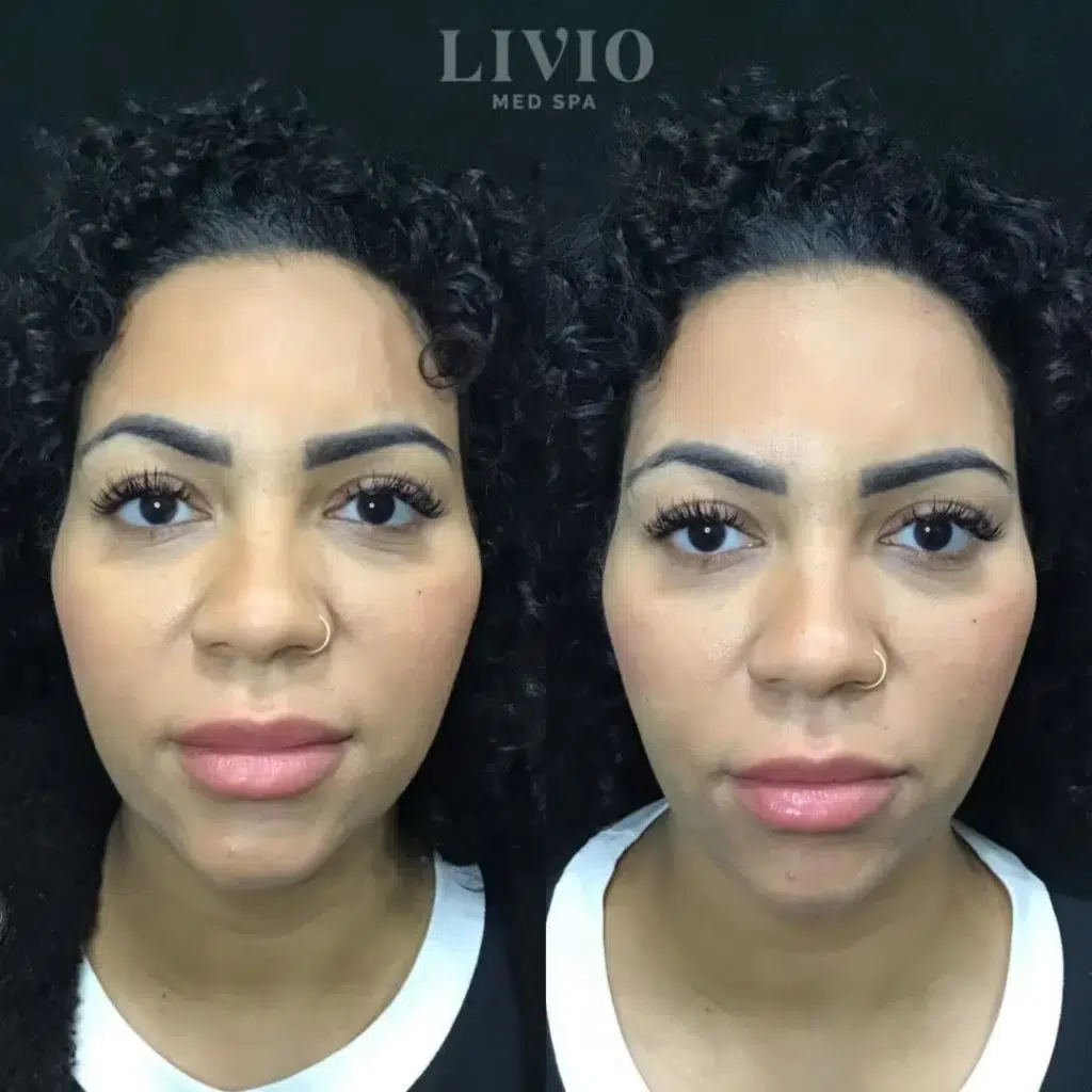 cheek filler before and after photo by livio med spa in cincinnati oh