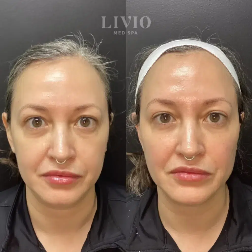 cheek filler before and after photo by livio med spa in cincinnati oh