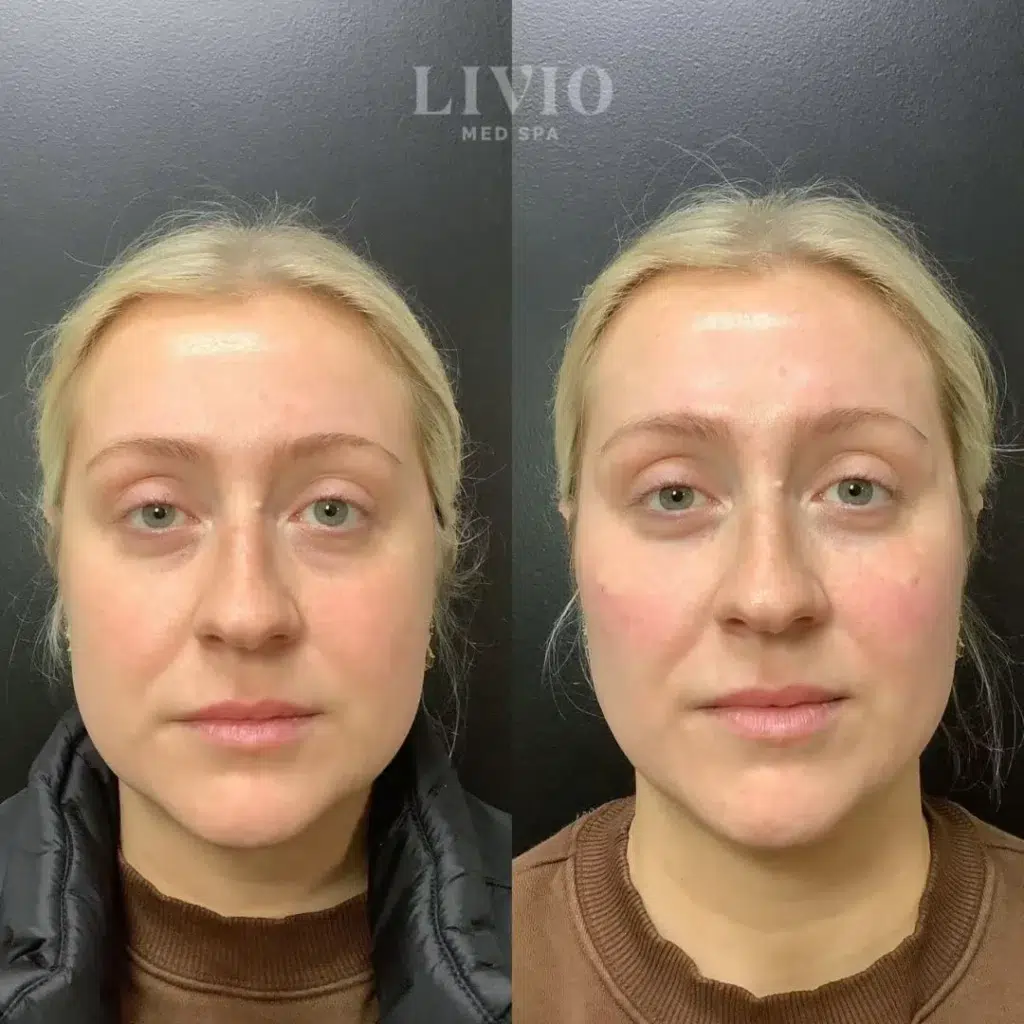 cheek filler before and after photo by livio med spa in cincinnati oh