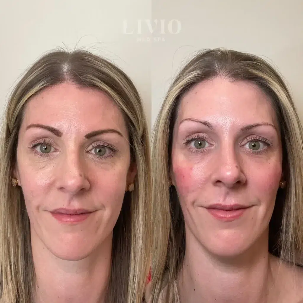 cheek filler before and after photo by livio med spa in cincinnati oh