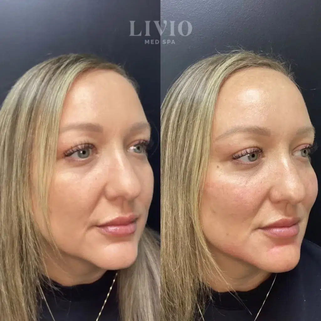 cheek filler before and after photo by livio med spa in cincinnati oh