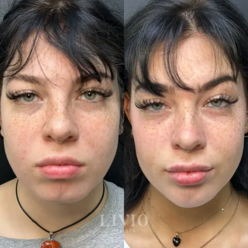chin filler before and after photo by livio med spa in cincinnati oh