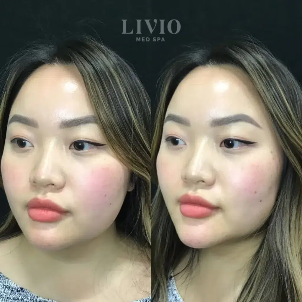 chin filler before and after photo by livio med spa in cincinnati oh