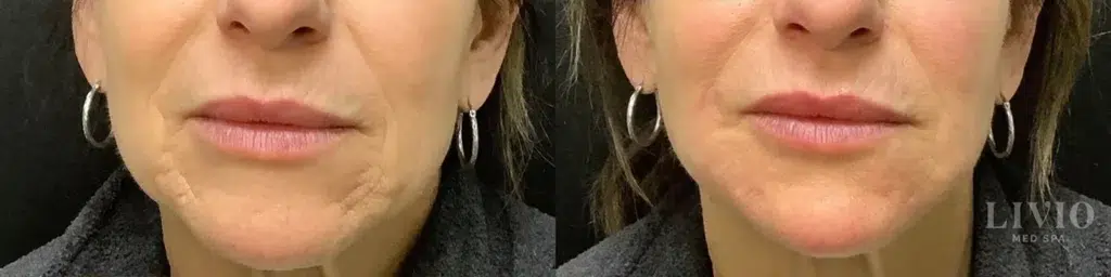 chin filler before and after photo by livio med spa in cincinnati oh