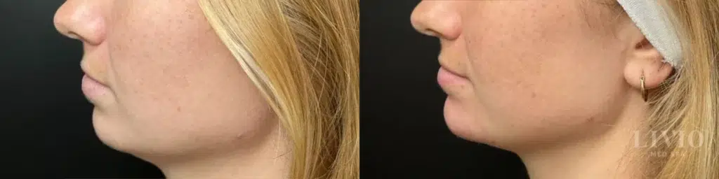 chin filler before and after photo by livio med spa in cincinnati oh