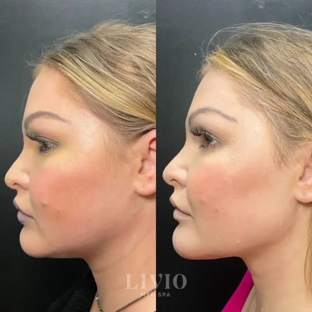 chin filler before and after photo by livio med spa in cincinnati oh
