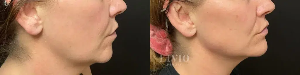 chin filler before and after photo by livio med spa in cincinnati oh