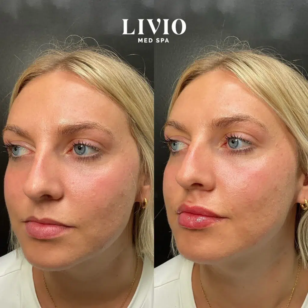 lip filler before and after photo by livio med spa in cincinnati oh