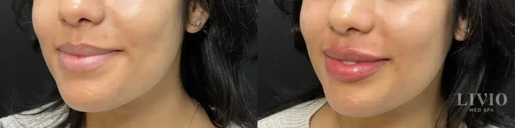 lip filler before and after photo by livio med spa in cincinnati oh