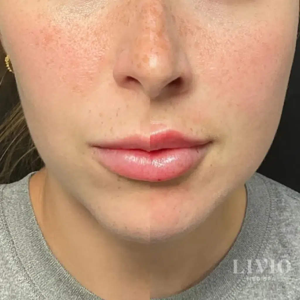 lip filler before and after photo by livio med spa in cincinnati oh