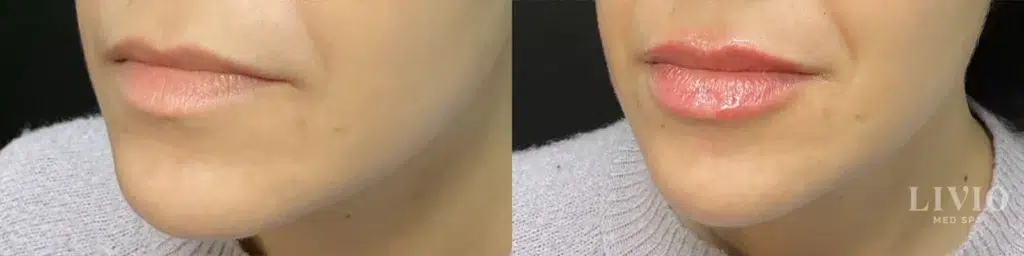 lip filler before and after photo by livio med spa in cincinnati oh