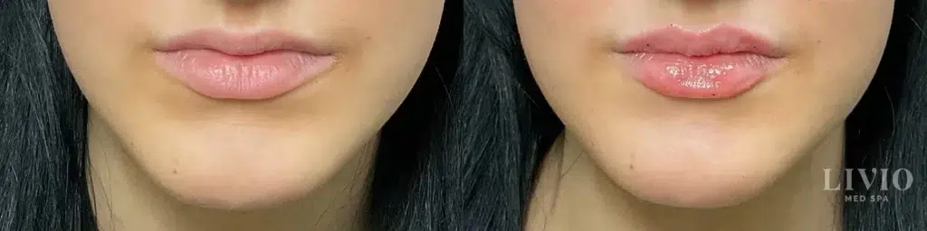 lip filler before and after photo by livio med spa in cincinnati oh