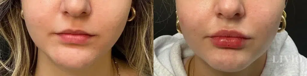 lip filler before and after photo by livio med spa in cincinnati oh