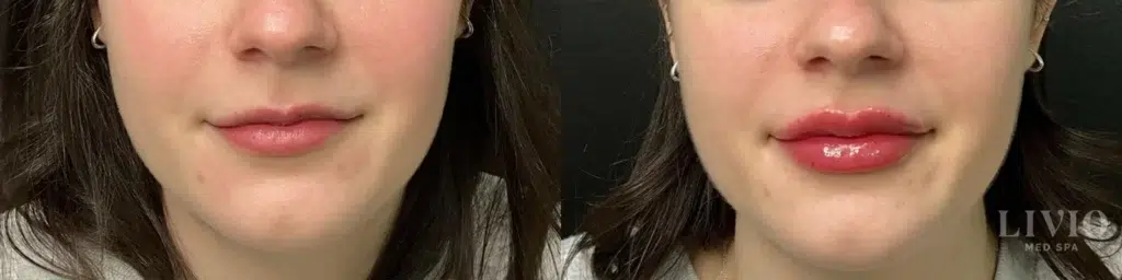 lip filler before and after photo by livio med spa in cincinnati oh