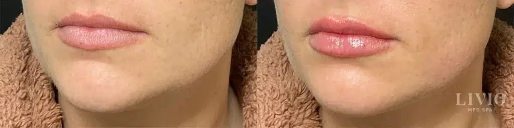 lip filler before and after photo by livio med spa in cincinnati oh
