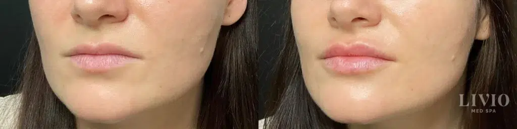 lip filler before and after photo by livio med spa in cincinnati oh