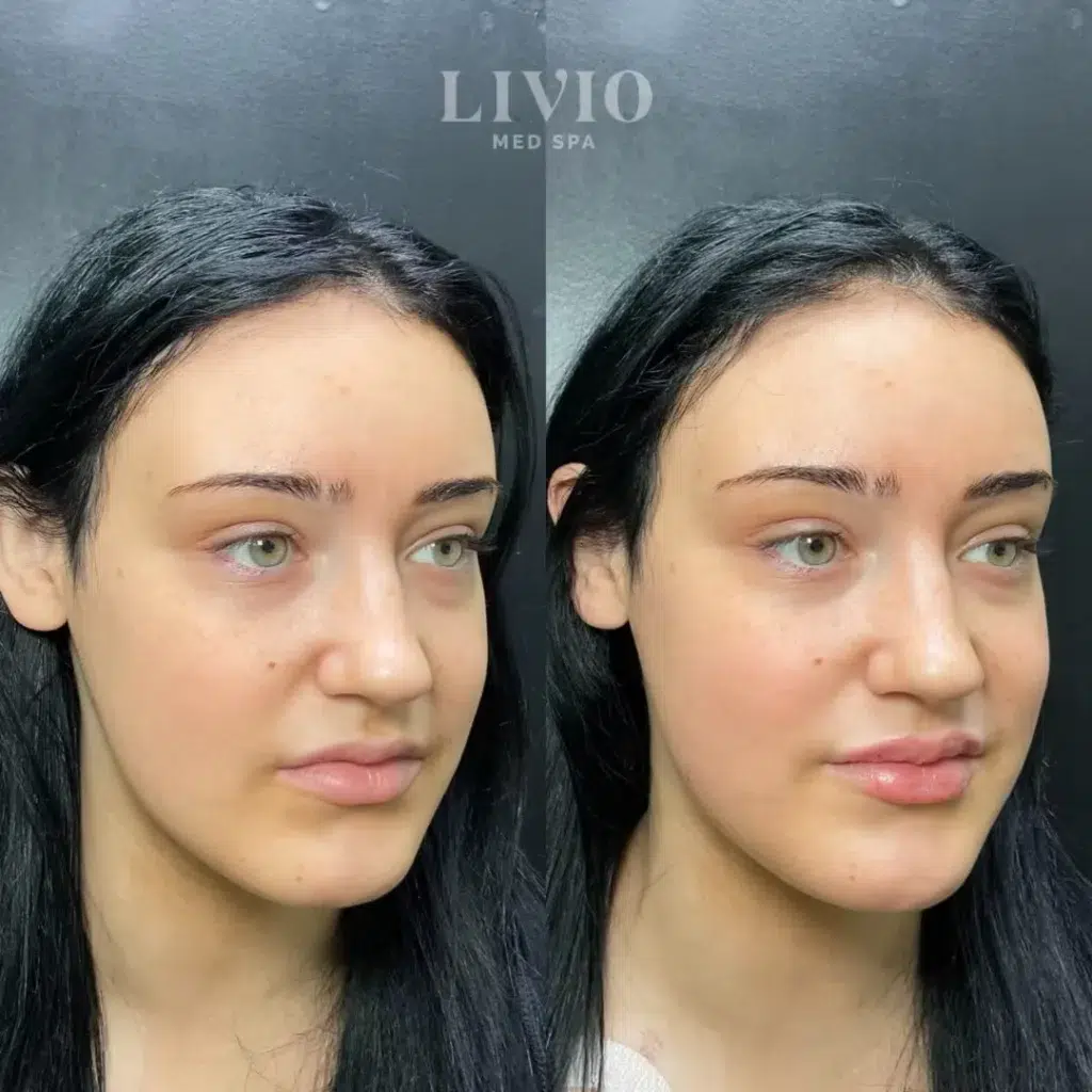 lip filler before and after photo by livio med spa in cincinnati oh