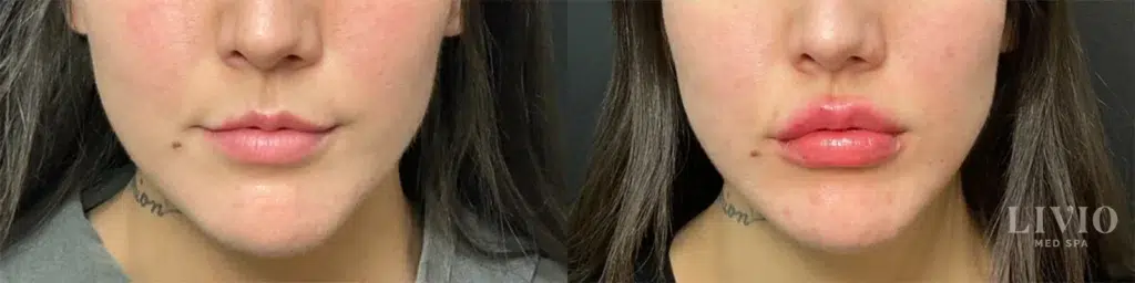 lip filler before and after photo by livio med spa in cincinnati oh
