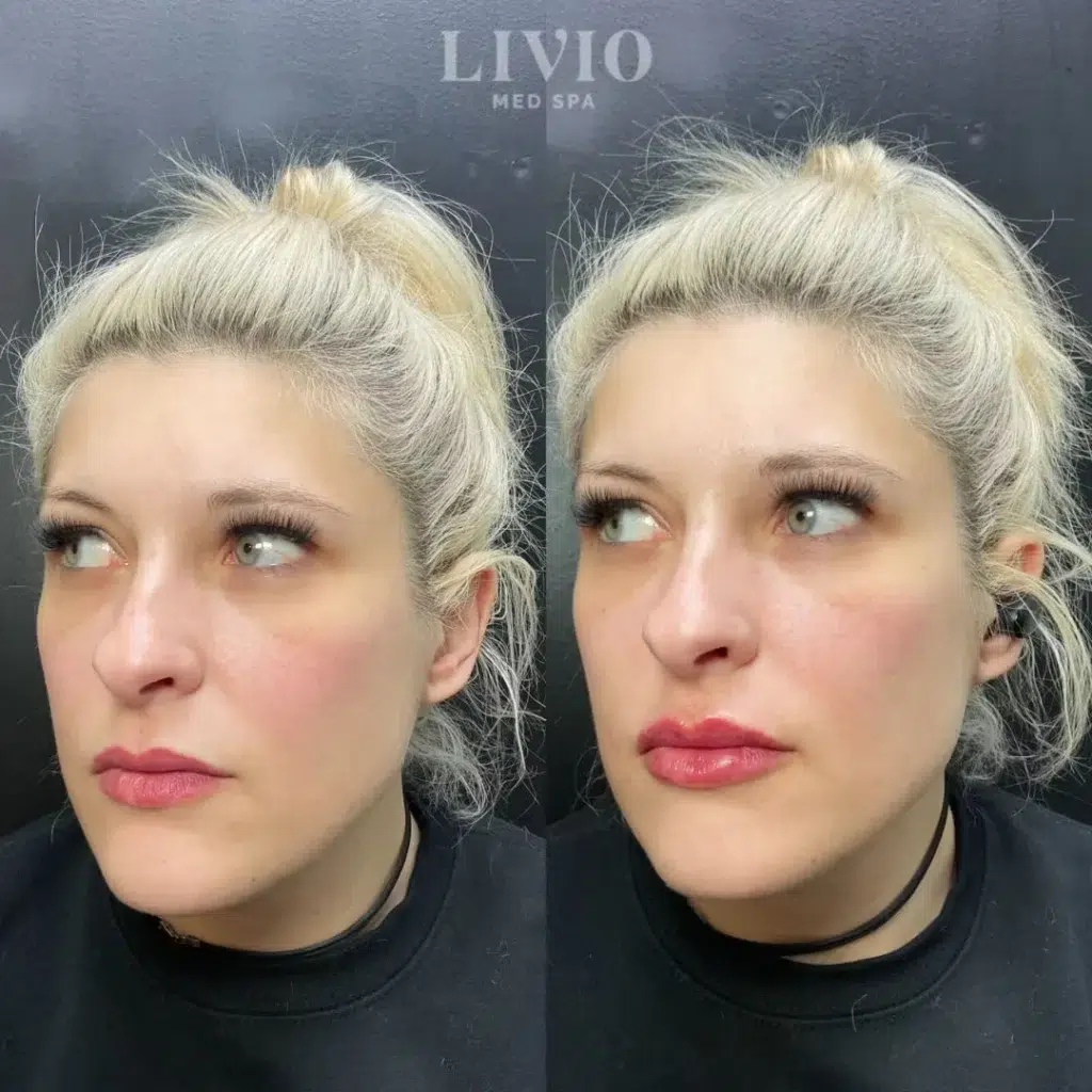 lip filler before and after photo by livio med spa in cincinnati oh