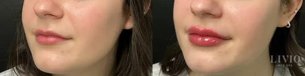 lip filler before and after photo by livio med spa in cincinnati oh