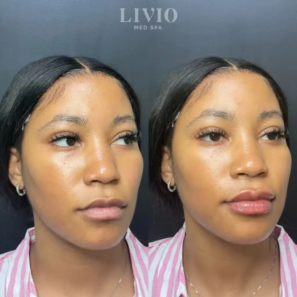 lip filler before and after photo by livio med spa in cincinnati oh