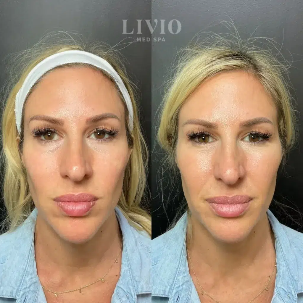full face filler before and after photo by livio med spa in cincinnati oh