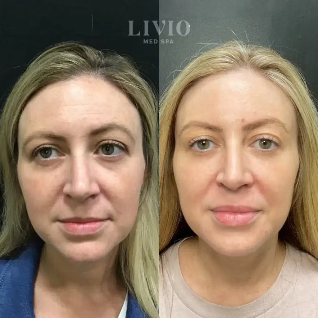 full face filler before and after photo by livio med spa in cincinnati oh