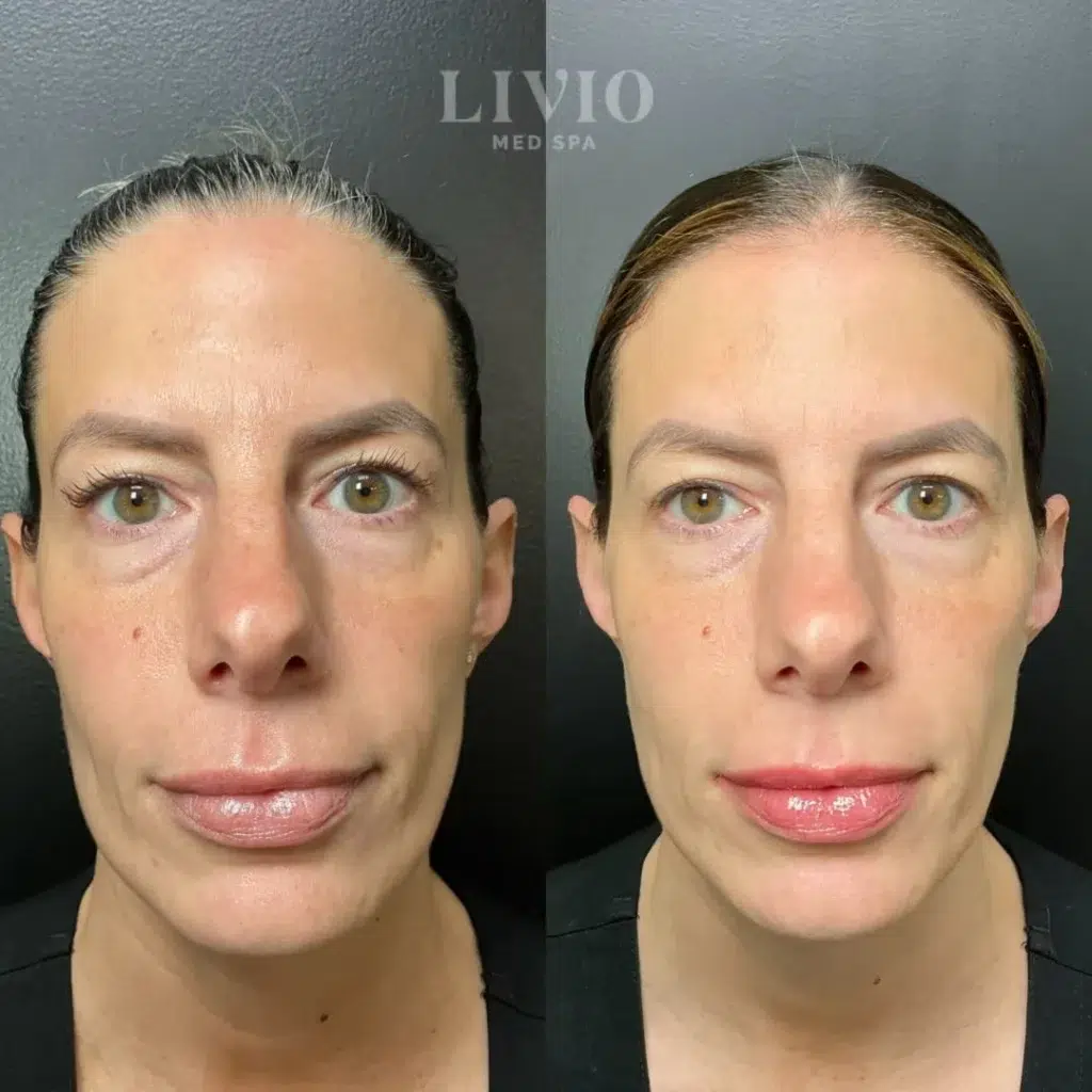 full face filler before and after photo by livio med spa in cincinnati oh