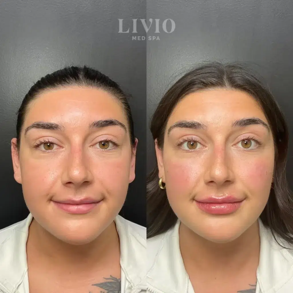 full face filler before and after photo by livio med spa in cincinnati oh
