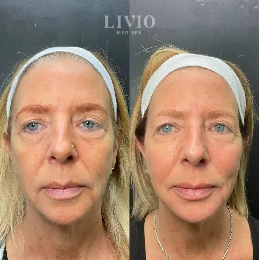 full face filler before and after photo by livio med spa in cincinnati oh
