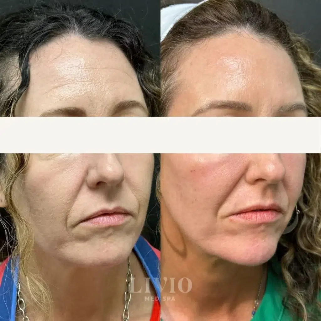 full face filler before and after photo by livio med spa in cincinnati oh