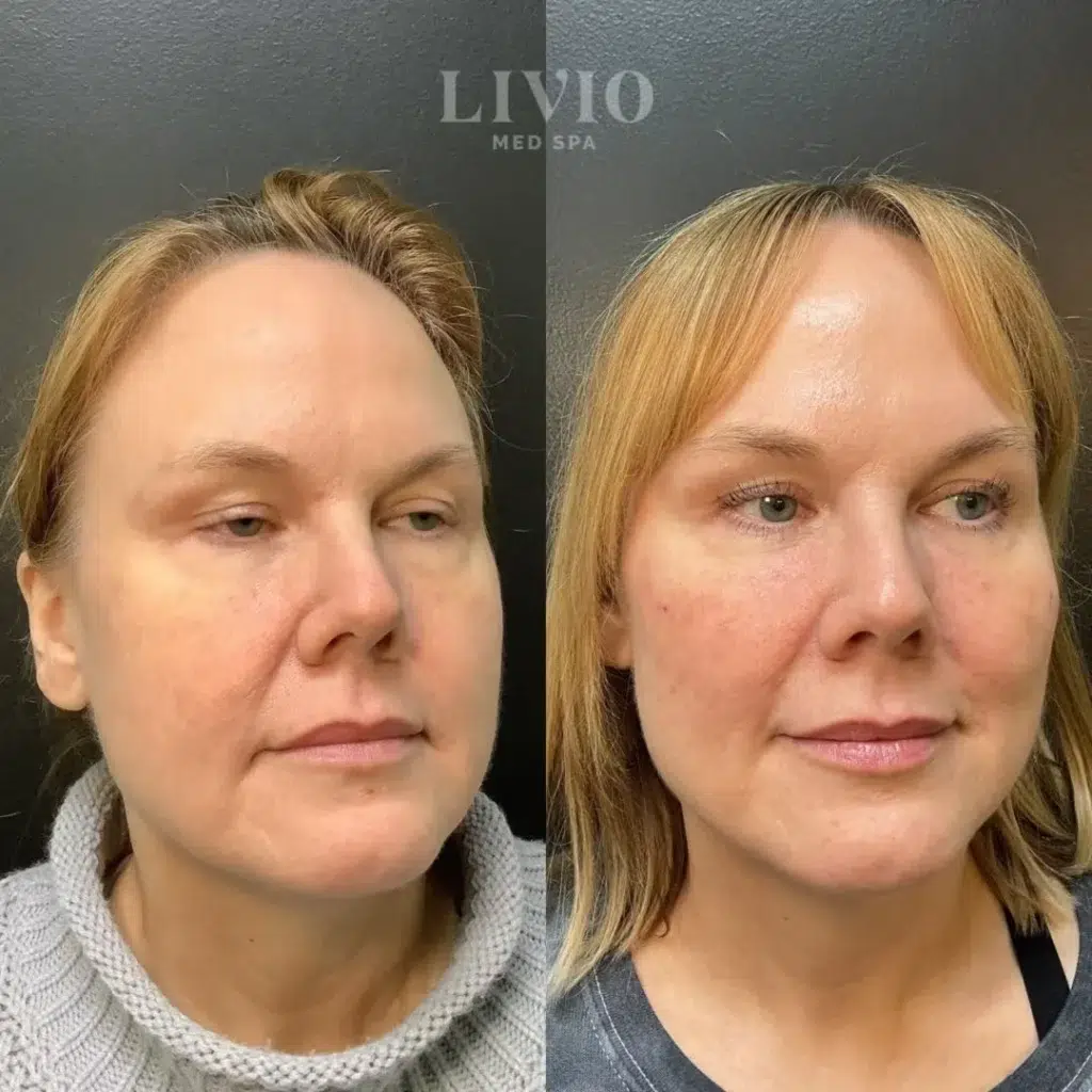 full face filler before and after photo by livio med spa in cincinnati oh