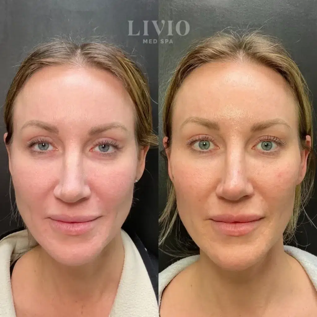 full face filler before and after photo by livio med spa in cincinnati oh