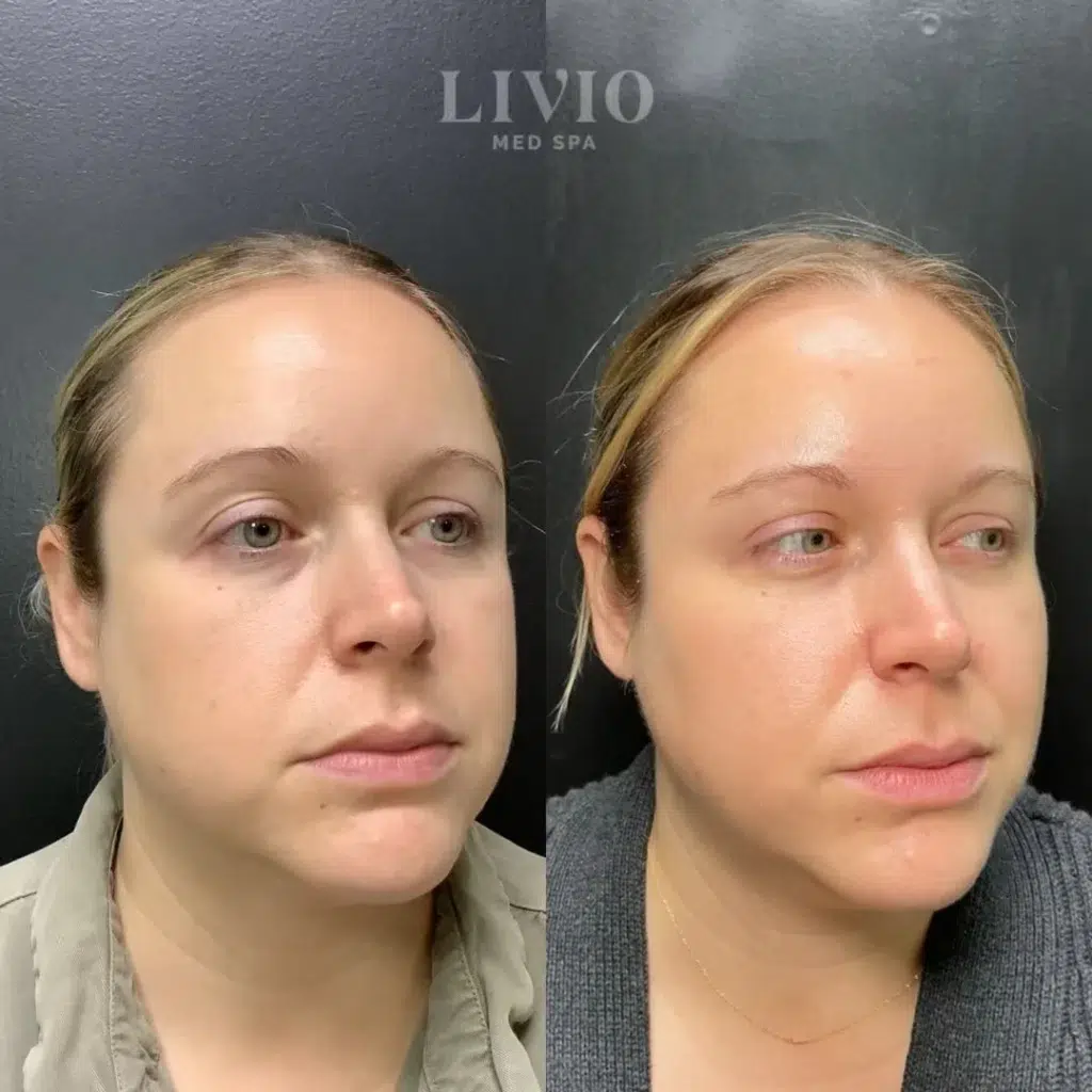under eye filler before and after photo by livio med spa in cincinnati oh