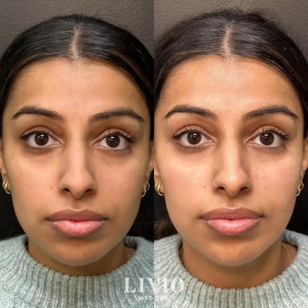 under eye filler before and after photo by livio med spa in cincinnati oh